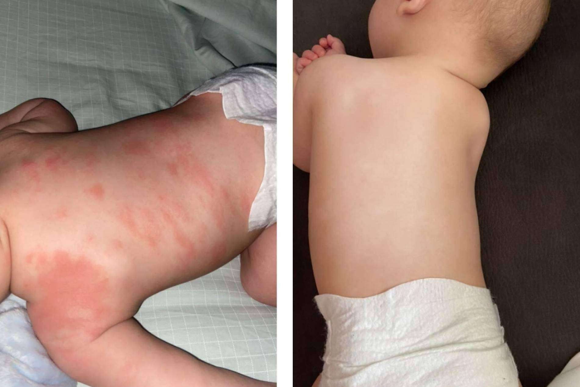 El antes y después de usar la crema hidratante en pieles atópicas de Green Cornerss