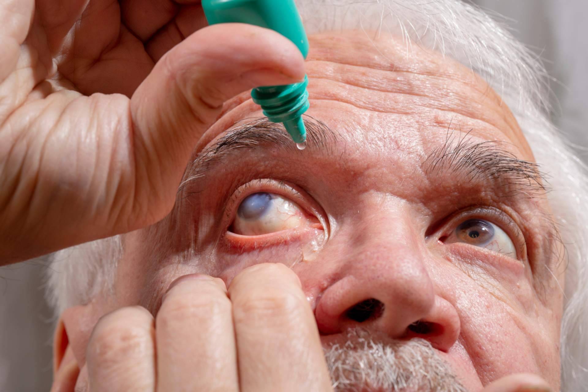 ¿Cuáles son los síntomas y tratamientos del glaucoma?, por Departamento de Oftalmología del Hospital Universitario Dexeus