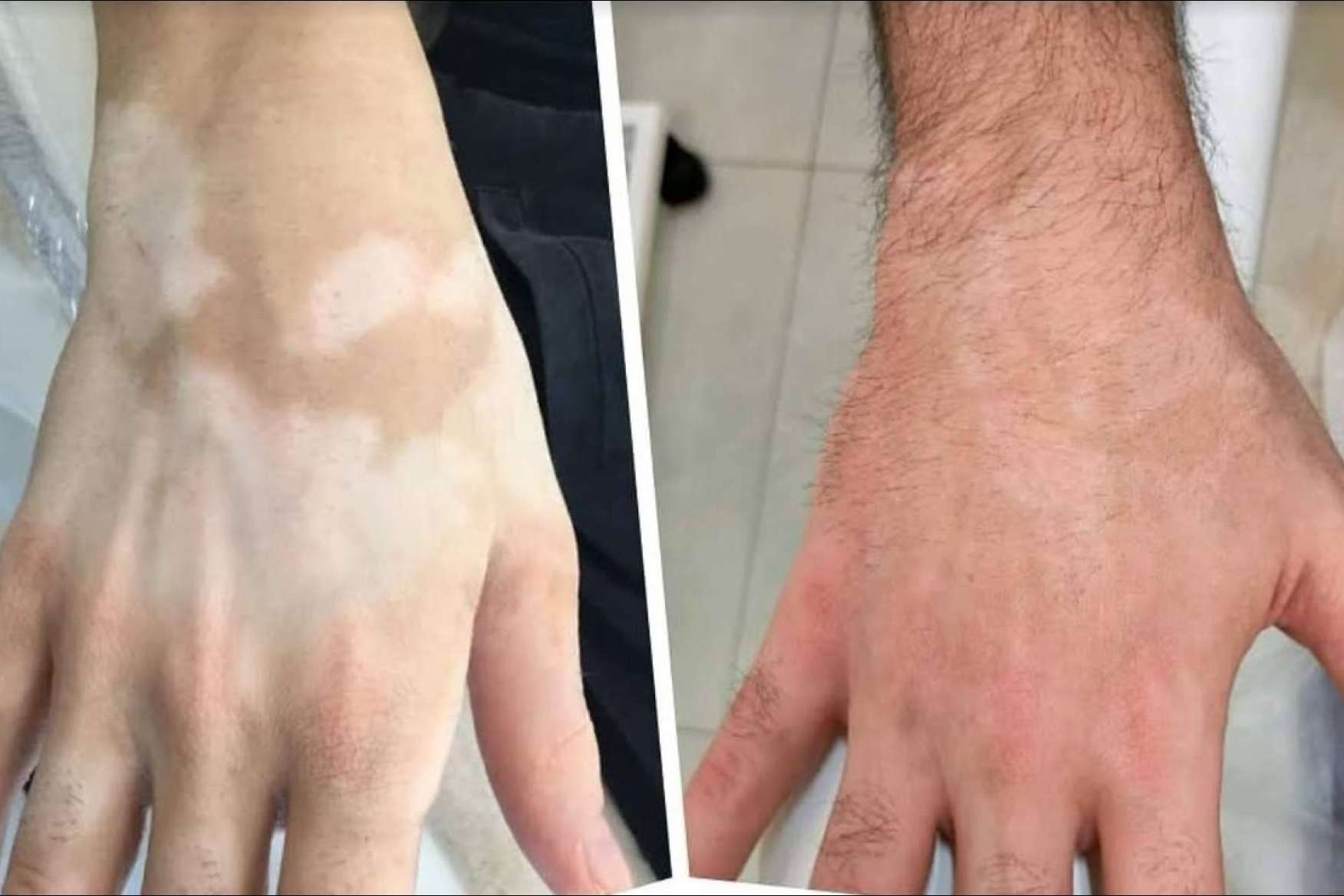 TERAV tratamiento estético de repigmentación artificial para vitiligo