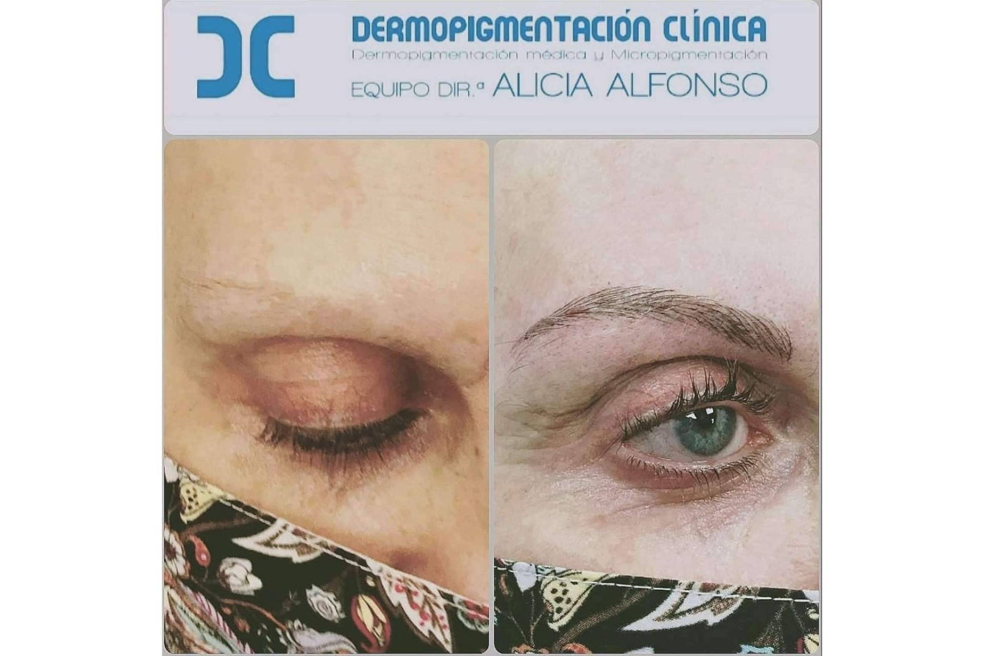Diferencias entre micropigmentación y microblading