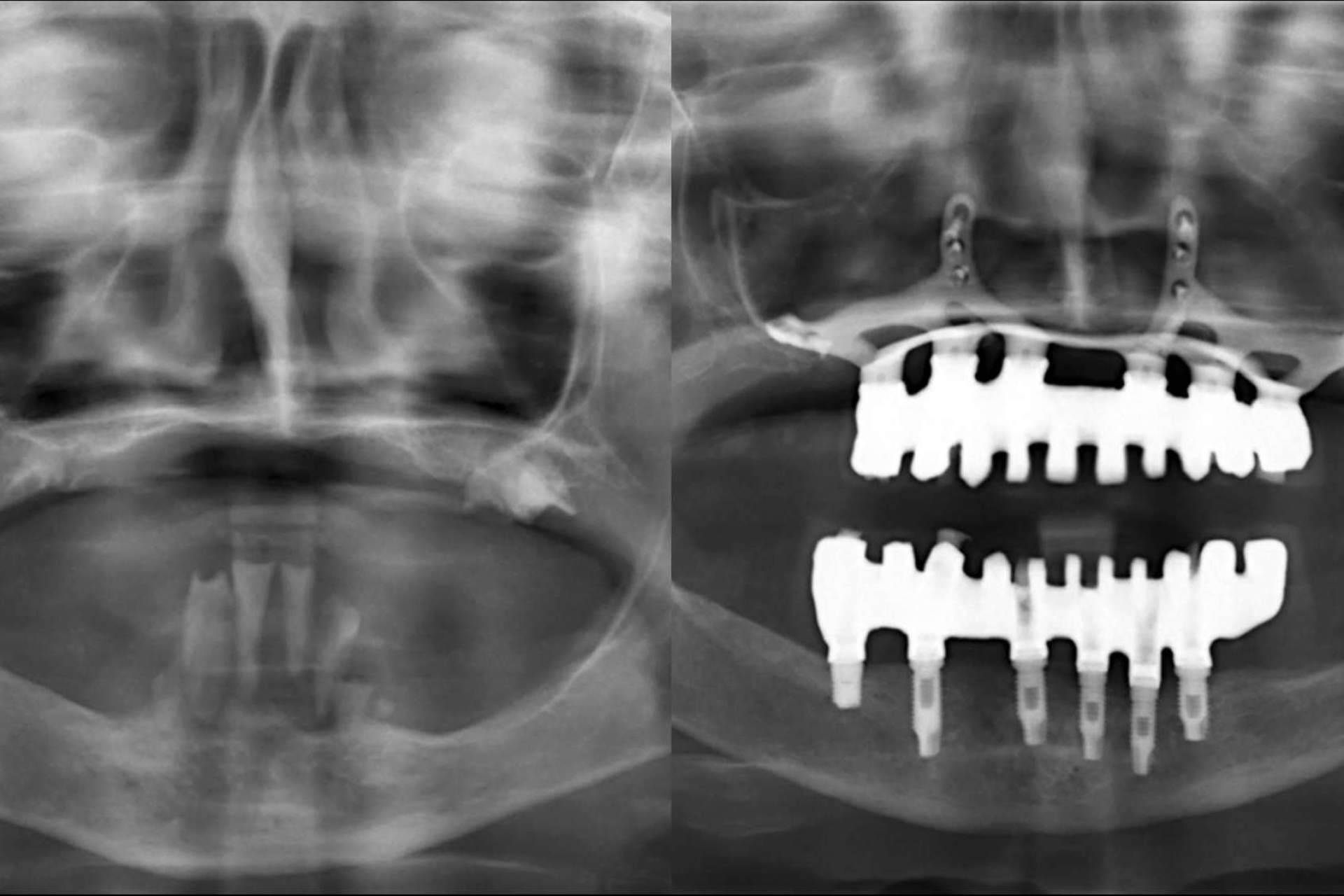 Servicios en implantes dentales con los especialistas de la Clínica Calvo de Mora en Madrid