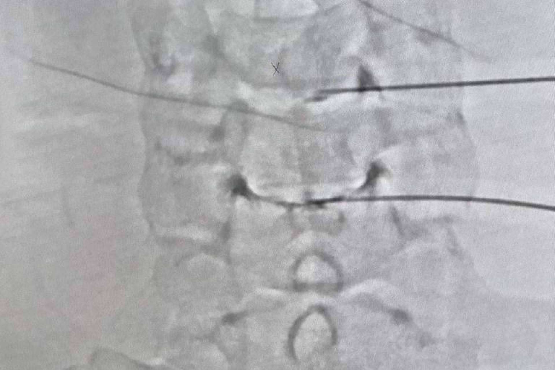 Ozonoterapia para hernia discal; el resultado se mantuvo 10 años después de la disolisis en el 88% de los casos
