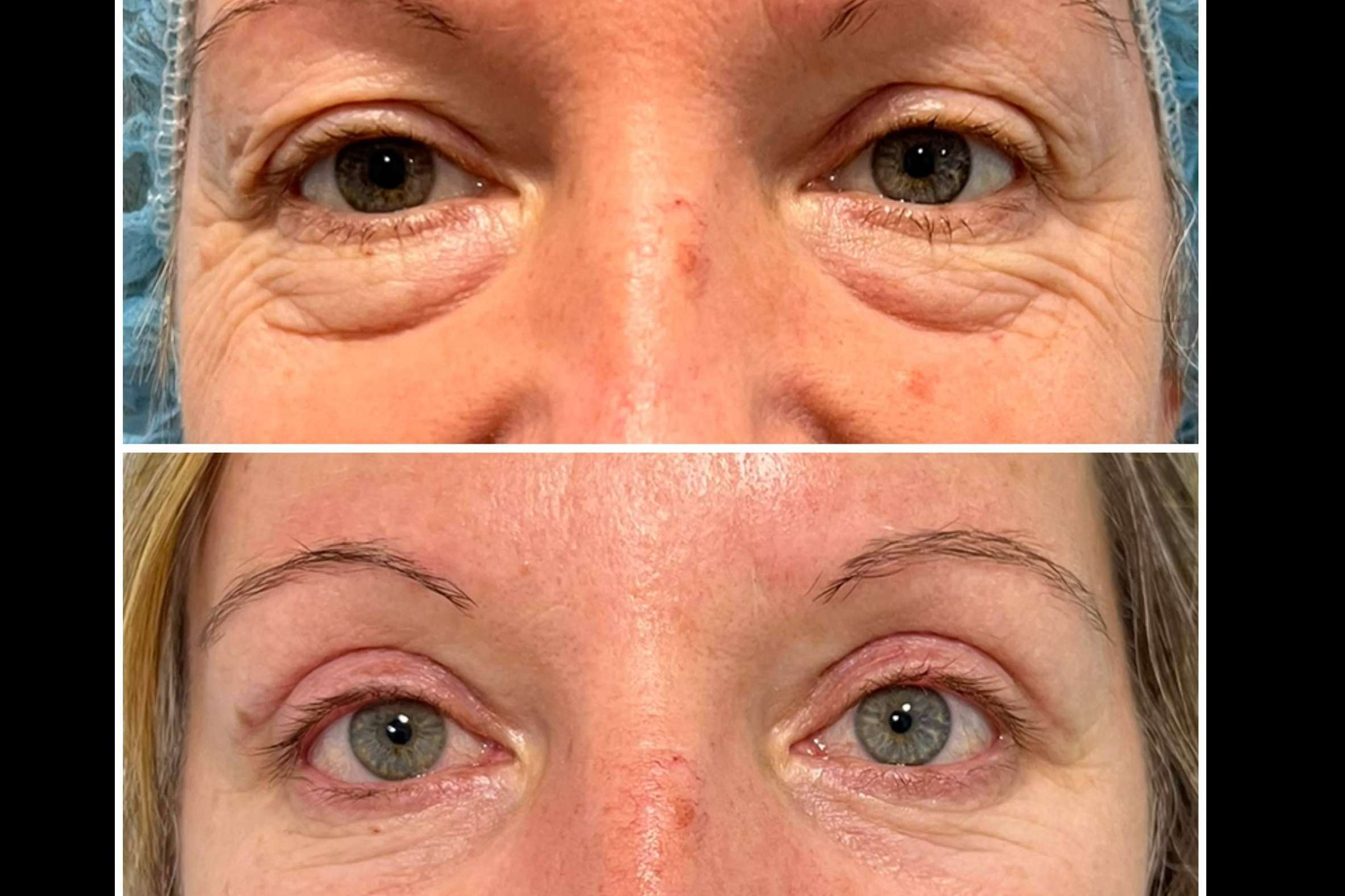 La Clínica Jiménez Ortiz detalla qué es la blefaroplastia y cuáles son sus beneficios