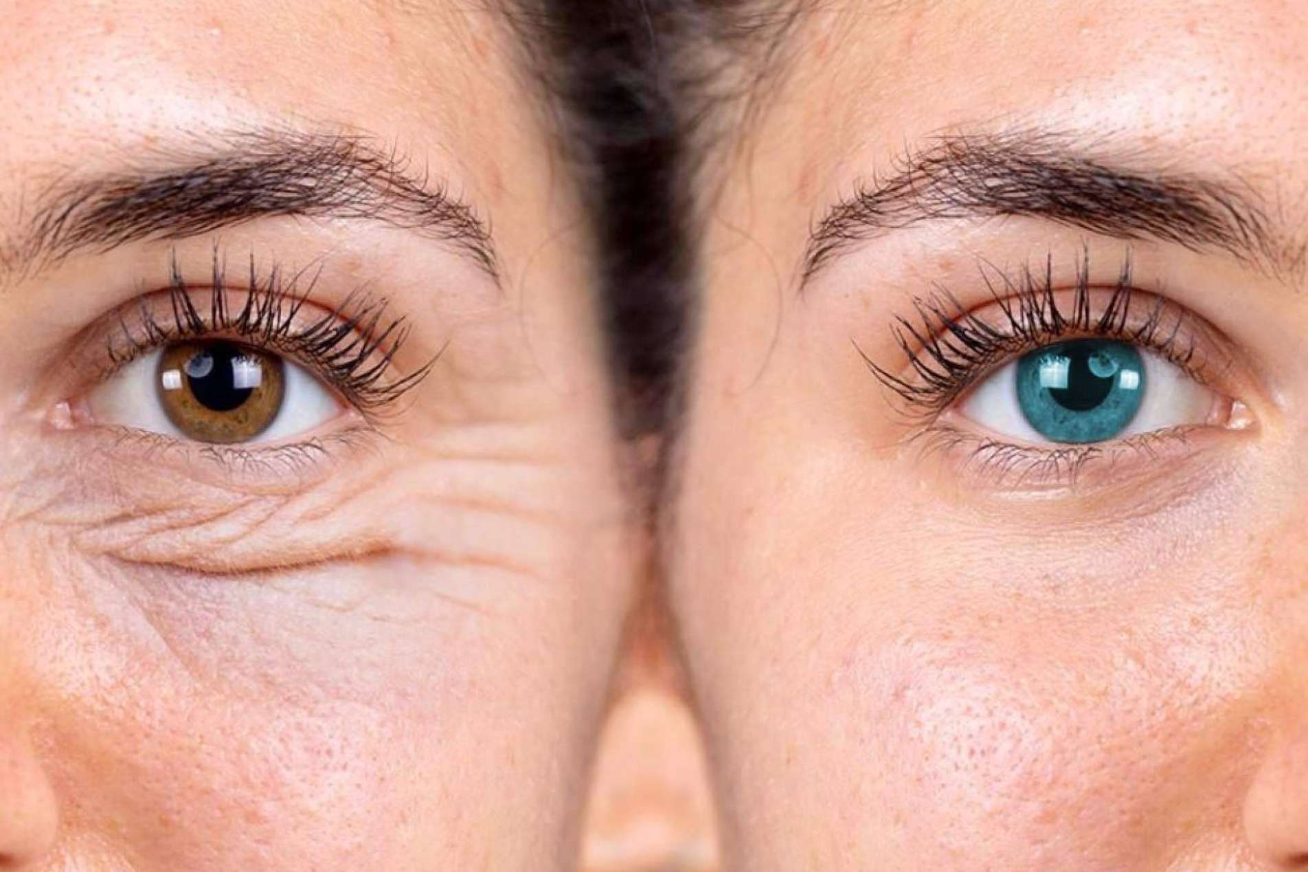 ¿Cuáles son los mayores beneficios de las blefaroplastias con láser sin cirugía?
