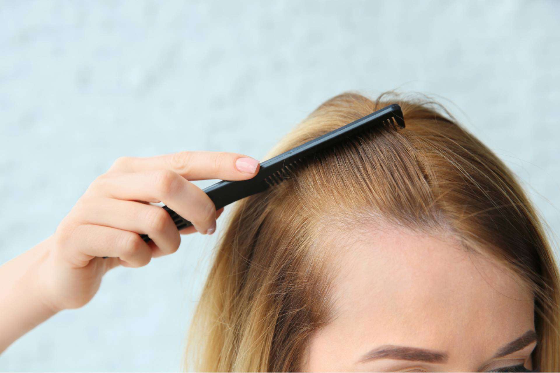 Alopecía androgénica; cómo afecta la caída del cabello a hombres y mujeres, por el Institut Mèdic DaVinci