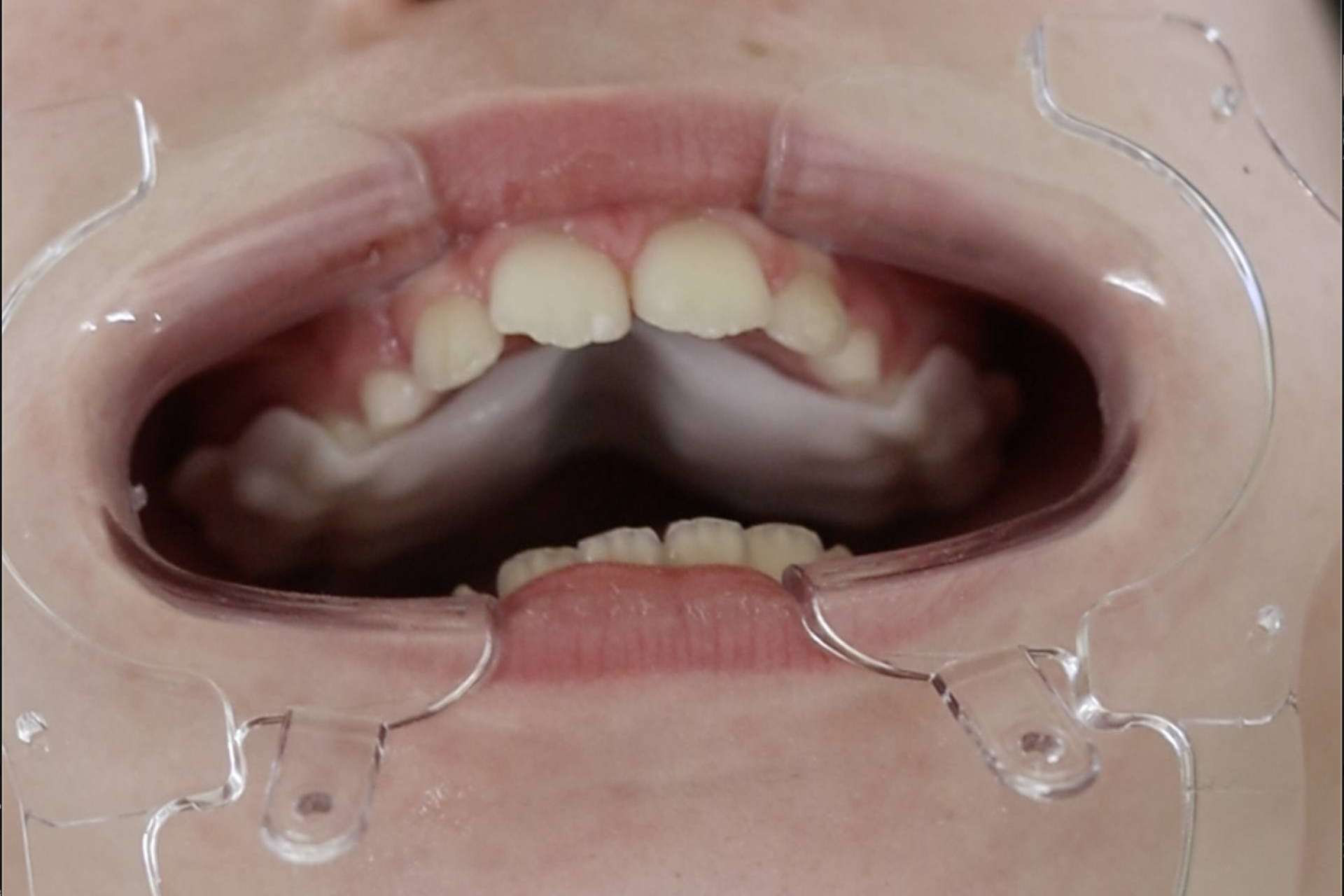 Smart Aligner Services da la bienvenida al Palatal Expander en su evento 'Expansión Dental y esquelética'