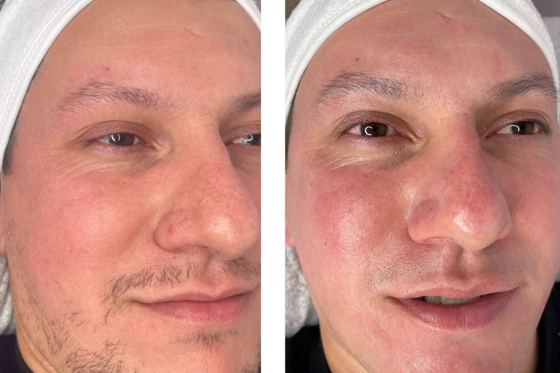 Tratamientos como dermapen, aplicación de colágeno, lifting de pestañas y laminacion de cejas