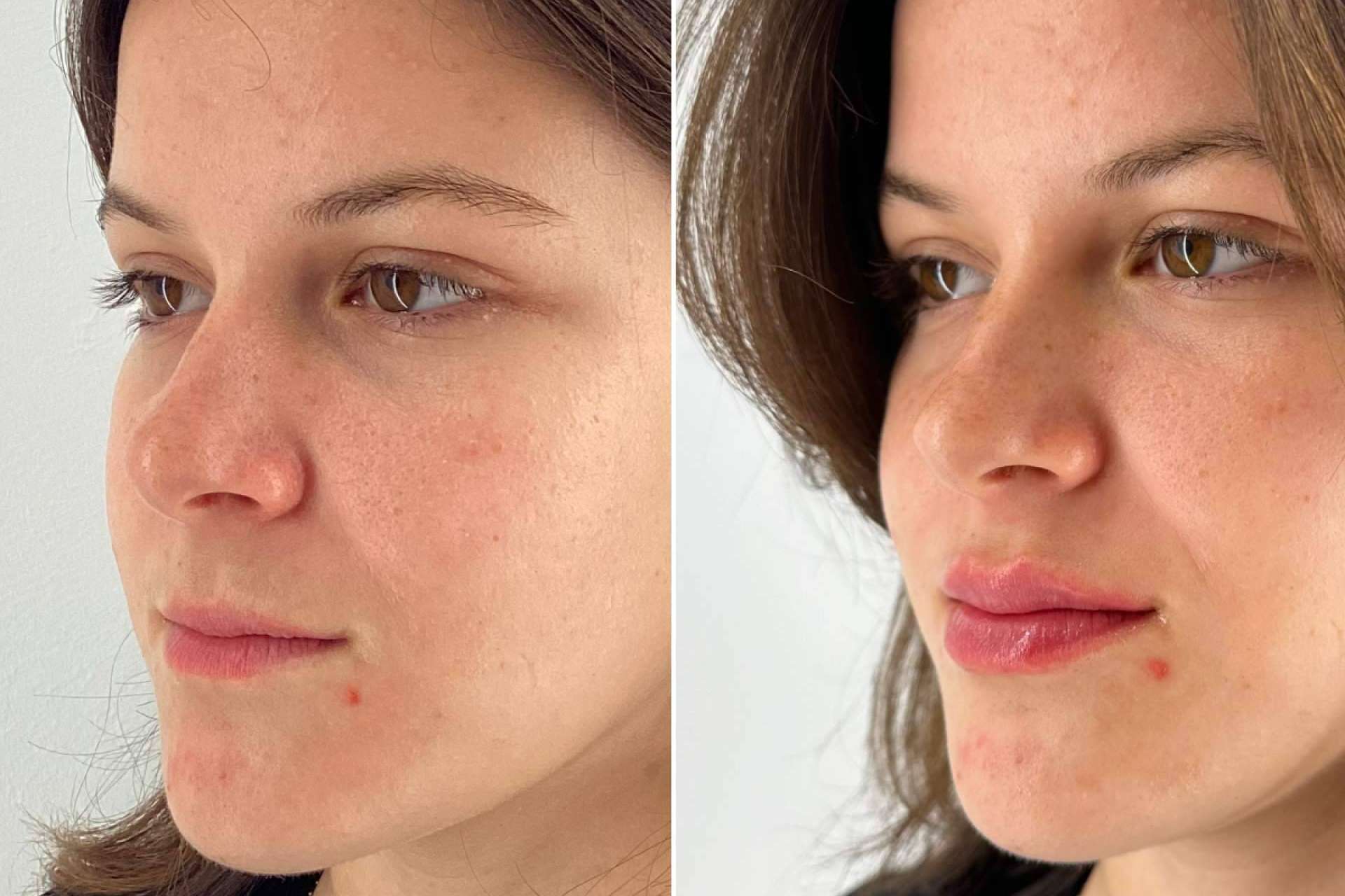 Holaglow revoluciona la armonización labial con Glow Lips, un tratamiento de precisión y naturalidad