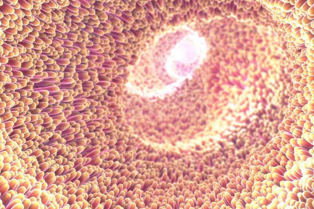 Colon irritable; Un diagnóstico impreciso que en muchos casos oculta trastornos reversibles y tratables
