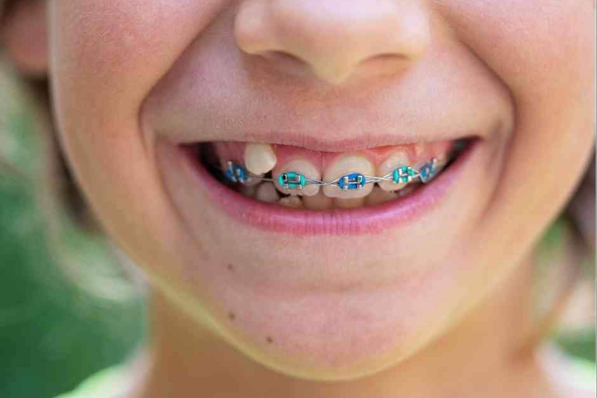 Ortodoncia infantil; guía para una sonrisa saludable desde pequeños