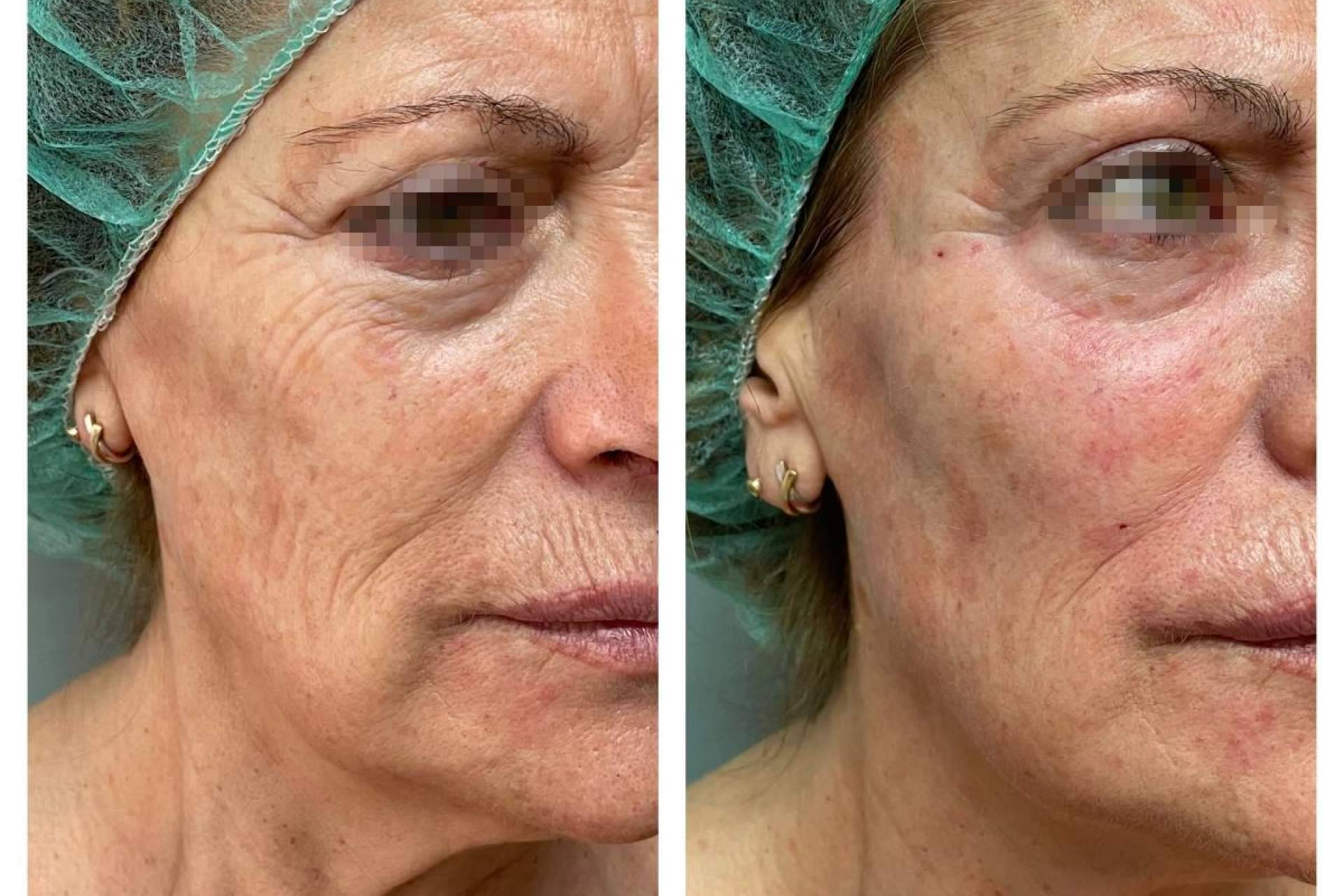 ¿Por qué el lipofilling facial se posiciona como la opción preferida sobre el ácido hialurónico en 2026?